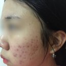 제산한의원 | 여드름 한의원 가격과 다녀본 후기