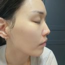 연화제 | 블랙헤드 제거 고민하다가 써본 아나시스 피지연화제 리얼 후기