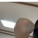 모모반점 | [공지] 아토피 자연치유후기