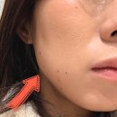 범계닥터에버스의원 | 저렴한 천호역 피부과 닥터에버스의원 보톡스 1만원? 내돈내산후기