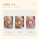비유네일 | 긴 엄지발가락때문에 발톱무좀이 되었다?!?!🧐 동작구 무좀전문 【수요네일】 관리 후기