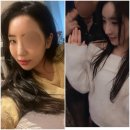 살찐코양이 | 코 필러 맞고 아바타 코 됐던 썰 푼다. +입술 필러 부작용 전후 공개 찐 후기