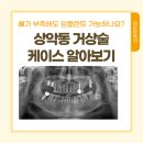 부암치과의원 | 개금 신세계치과 상악동 거상술 + 임플란트 식립 후기 위 어금니 뼈 부족 해결한 실제 치료 과정 공개