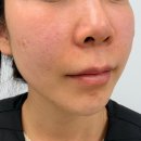 신사역 5번출구 앞 | 30대 눈밑꺼짐 신사역피부과 쥬베룩아이 다크써클 효과 후기