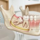 산본나란이치과의원 | 산본사랑니치과, 매복 사랑니 발치? 무서워서 미루고 계시다면