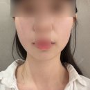 NO.1자동차피부과 | 인천 구월동피부과 포트라리프팅 효과 후기 얇은피부 통증적은 리프팅 추천