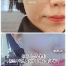 오보니 | 청담 피부과 쥬브아셀 리얼 후기 리투오보다? (팔자·앞볼)