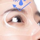 에이스안과의원 | 망막박리 공막동률술 후기 (5일차)