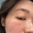 심정신건강의학과의원 | 아토피 피부가 미라젠 의원 egf 관리 받은 후기