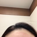 안*기 | 여드름 흉터 레이저 8회차 후기 | 울트라클리어 피코프락셀 통증, 붉은기 솔직 후기