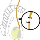 원일로 115번길 | 무도정관수술 (No-Scalpel Vasectomy)/원주비뇨기과 연세플러스