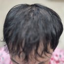 마스터가발 김호증모 영등포 | 남성 탈모, 왜 증모술을 선택할까?