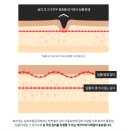BB성형외과의원 | 실리프팅후기 투명브이리프팅 효과보려면 꼭 알아야할 이것