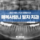 매복사랑니발치 치과 잇몸이 벌어진 케이스 후기