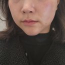 세븐일레븐대구현대점 | 대구 다이어트 대구 리프팅 잘하는곳! 스톤관리로 등 다시 태어난 리얼후기