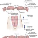 arcuate line 구분에 따른 앞쪽 복벽의 구조적 차이 이미지