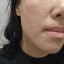 손주사 대신 더마샤인 리쥬란 힐러, 강남피부과 스킨부스터 통증 효과 가격 내돈내산 후기!
