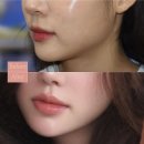 입술확대수술후기 5개월차(위, 아래 동시), 병원선택 팁까지