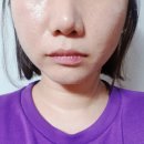지성경로당 | 한남동피부관리로 유명한 앙드더한남에서 부작용없는 윤곽관리인 라인젯으로 심부볼, 이중턱관리
