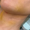 꿀잠:실 | [서울] 내돈내산 이중턱 지방흡입/ 이중턱 지흡/실 리프팅 리얼후기/딤플부작용 없어진 후기