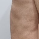 정체기가 살짝 왔지만 7주 차 뱃살지방분해주사 순항 중인 건강한 다이어트후기