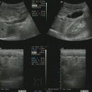 Perforated appendicitis 이미지