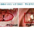 목에서 가끔 냄세가 지옥한 노란 알갱이 나오나요? (수정 필독) 이미지