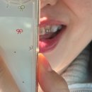 선이고운연세치과의원 | 32살 교정 일기 시작-☆ 교정 고민부터 윗니 교정 브라켓까지