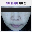 강동-천호-1255 | 천호 피부과, 어려운 기미, 흑자 제거 치료가 효과를 본 이유는?