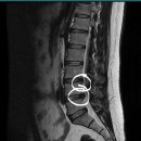스마튼병원 | 4,5번 허리디스크(추간판 탈출증) 후기 feat. 부천 스마튼병원 MRI, 주사 후기-내 돈 내산