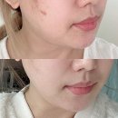 더마펌 | 붓기제거 올리브영추천템! 펩타이드 더마펌 스킨텐션 패치 후기