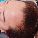 M자 이마 고민 끝! 창동 헤어라인문신 만족 후기