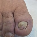 엔비뷰티 | 석적 구미 파고드는 발톱 관리 내성 발톱 후기! 뷰티엔비 석적점 요양원 봉사 이야기
