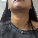 국도약국 | 내돈내산 리모성형외과 이중턱살제거를 위한 근육묶기 당일부터 일주일차까지 투턱없애기 후기