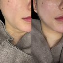 디자인페이스 | 강남 피부과 튠페이스 내돈내산 후기 튠라이너 맞춤 디자인으로 자연스러운 리프팅 효과