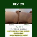 송파복부사후관리ㅣ복부 지흡 사후관리 종결! 1회 만에 무거운 붓기 탈출 성공한 리얼 후기👍🏻