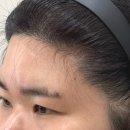 인천송도성형외과 이마거상 + 한쪽 눈 자연유착으로 비대칭 교정 성공 리얼후기
