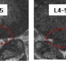 발렌님의 요추디스크 L4-5 MRI 판독입니다. 이미지