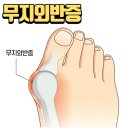 트레이닝 메이트 | 삼전PT, 잠전초등학교PT, 재활운동, 체형교정운동은 트레이닝메이트] 무지외반증에 의한 발가락 통증 사례