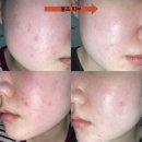 피부짱화장품 | [ 블립 ] 온갖 문제성피부를 개선시켜준 약보다 더 약같은 비건화장품 !!