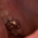 양지바른치과의원 | 서초 방배동 양지바른치과 인레이 충치치료 후기, 치중진단 유튜브 치과