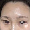 트러블크림 여드름크림 조가비 아크컨트롤카밍크림 사용 후기
