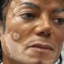 Michael Jackson Vitiligo(비틸라이고;백반증,白皮症) 이미지