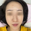 [광주 피부관리] 여드름피부, 리프팅, 수분관리 &lt;아임뷰티&gt; 콜드플라즈마 후기