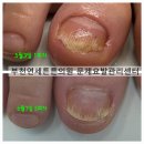 곡선연세가정의원 | 무좀, 결국 아이에게 전염됐습니다｜소아 무좀 실제 사례”[부천][인천][상동]연세튼튼의원 무좀치료1등