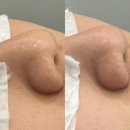 (주)태크노마트 | 블랙헤드 제거 전문샵 신도림 코피다 압출 모공 축소 후기