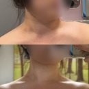 하나고주파 | 서울/압구정] 압구정 승모근관리 추천 ‘피티아(PYTHIA)’ 웨딩촬영 전 시그니처케어 고주파 림프관리 후기
