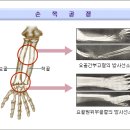 손목골절 이미지