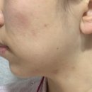 아르엘 에스테틱(AR’L Aesthetic) | 홍대 여드름 피부관리 아르엘 에스테틱 알라딘필링 후기
