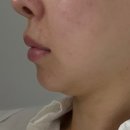 동안의원 | [Real Review] 서울동안의원 얼굴 지방흡입 솔직 후기 : 숨겨진 턱선 찾고 옆태 여신 된 썰